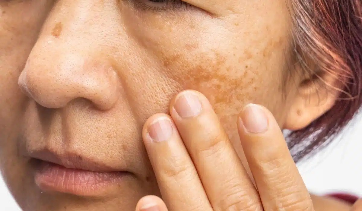 Descubre cómo diferenciar manchas y lunares en la cara | Multilaser Cara mendidik anak umur 4 tahun yang bandel